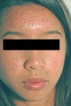 Acne treatments 1555.jpg